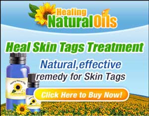 The Heal skin Tags treatment uses organic essential oils